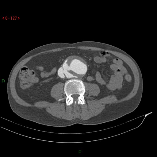Abdominal aortic aneurysm rupture with aortocaval fistula (Radiopaedia 14897-14841 Axial C+ arterial phase 127).jpg