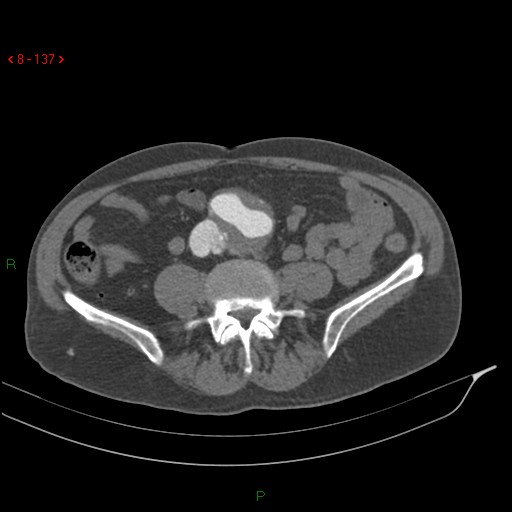 Abdominal aortic aneurysm rupture with aortocaval fistula (Radiopaedia 14897-14841 Axial C+ arterial phase 137).jpg