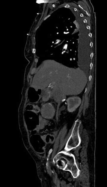 Abdominal aortic aneurysm with thrombus fissuration (Radiopaedia 73192-83919 Sagittal C+ arterial phase 101).jpg