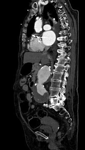 Abdominal aortic aneurysm with thrombus fissuration (Radiopaedia 73192-83919 Sagittal C+ arterial phase 75).jpg