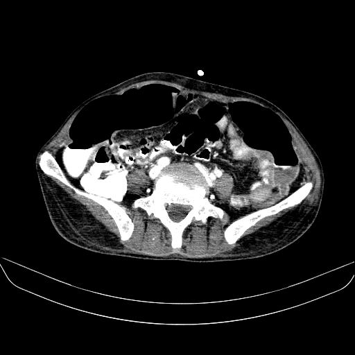 File:Abdominal collection due to previous cecal perforation (Radiopaedia 80831-94320 Axial C+ portal venous phase 133).jpg