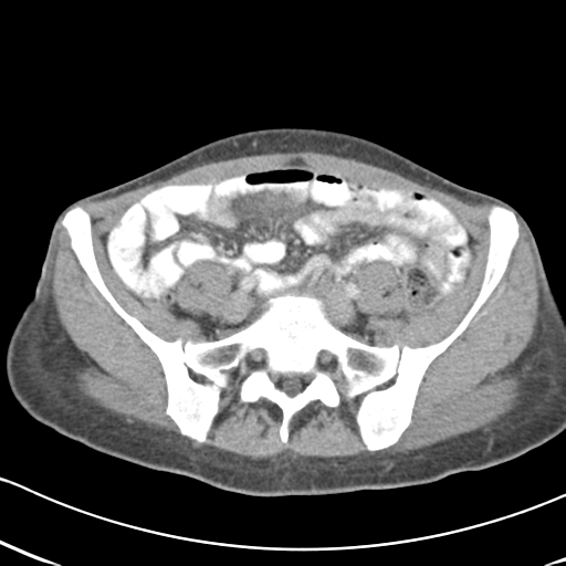 Abdominal desmoid tumor (Radiopaedia 41007-43740 Axial C+ portal venous phase 50).png