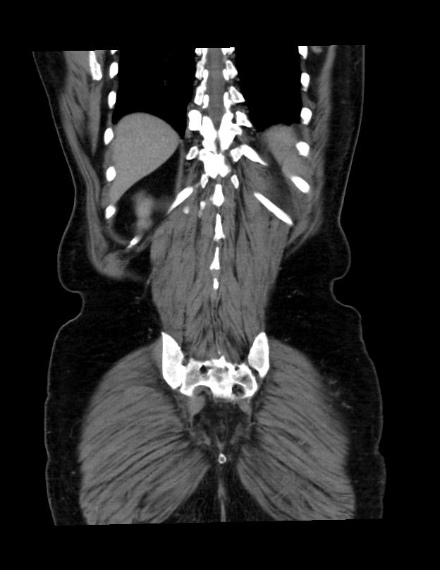 Abdominal lymphoma - with sandwich sign (Radiopaedia 53486-59492 C+ portal venous phase 8).jpg