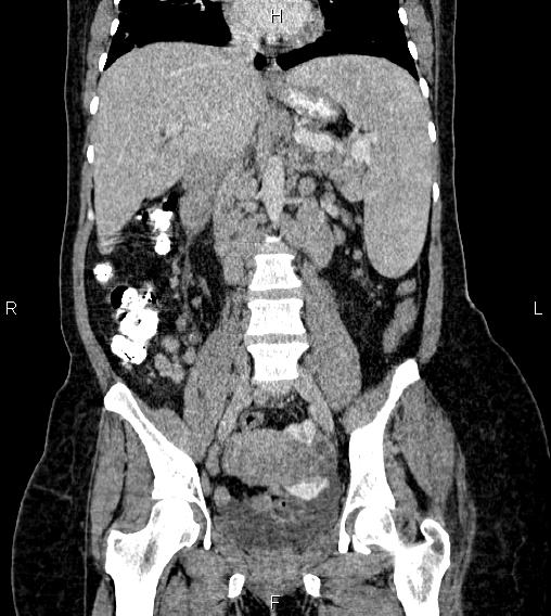 Abdominal lymphoma with sandwich sign (Radiopaedia 84378-99704 Coronal C+ portal venous phase 35).jpg