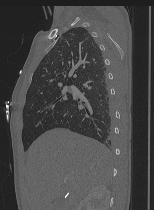 Abdominal multi-trauma - devascularised kidney and liver, spleen and pancreatic lacerations (Radiopaedia 34984-36486 Sagittal bone window 66).png