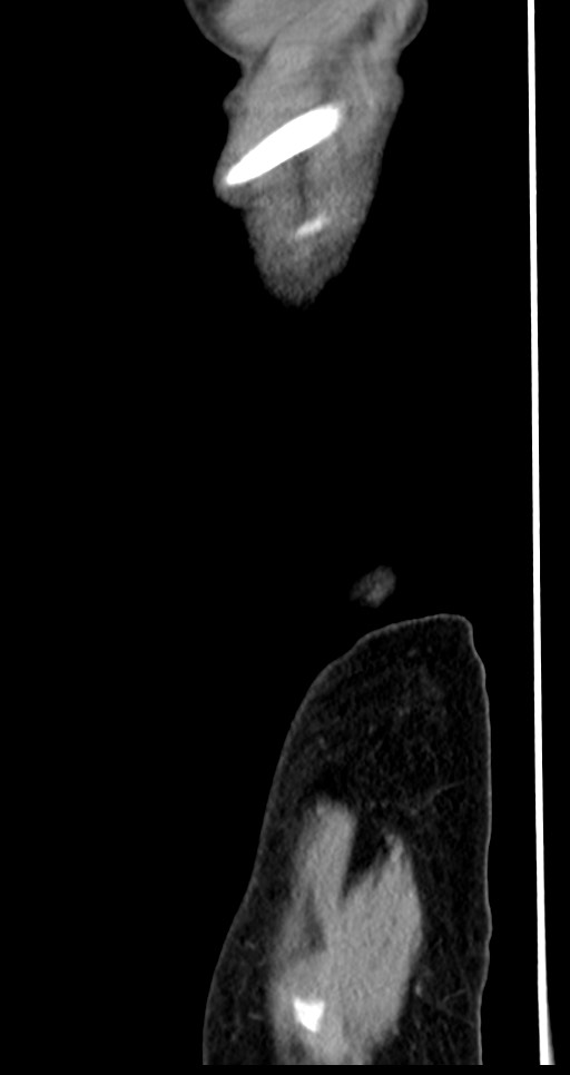 Abdominal wall and retroperitoneal tuberculosis (Radiopaedia 88137-104729 Sagittal C+ portal venous phase 145).jpg