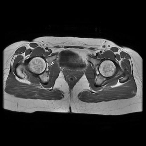 File:Abdominal wall endometriosis (Radiopaedia 83702-98847 Axial T1 15).jpg