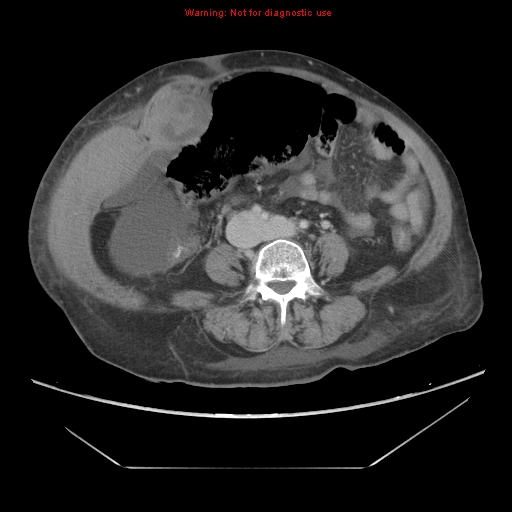 File:Abdominal wall hematoma (Radiopaedia 9427-10112 Axial C+ portal venous phase 65).jpg