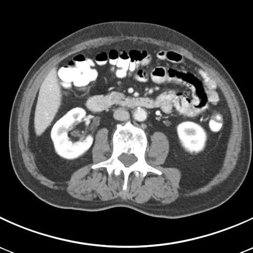 File:Abdominal wall metastasis from colorectal carcinoma (Radiopaedia 31016-31717 Axial C+ portal venous phase 36).jpg