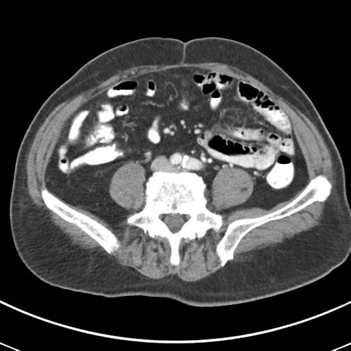 Abdominal wall metastasis from colorectal carcinoma (Radiopaedia 31016-31717 Axial C+ portal venous phase 48).jpg