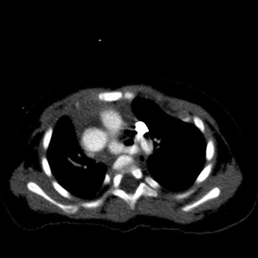 Aberrant left pulmonary artery (pulmonary sling) (Radiopaedia 42323-45435 Axial C+ CTPA 17).jpg