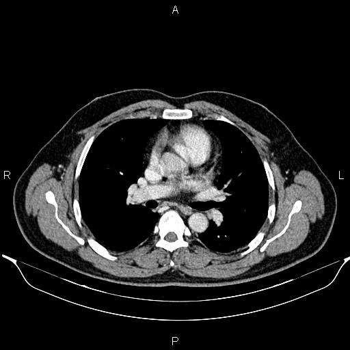 File:Aberrant right subclavian artery (Radiopaedia 87093-103354 Axial With contrast 53).jpg