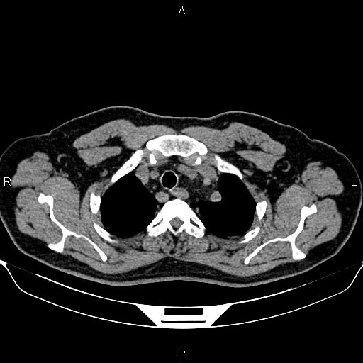 Aberrant right subclavian artery (Radiopaedia 87093-103354 Axial non-contrast 18).jpg