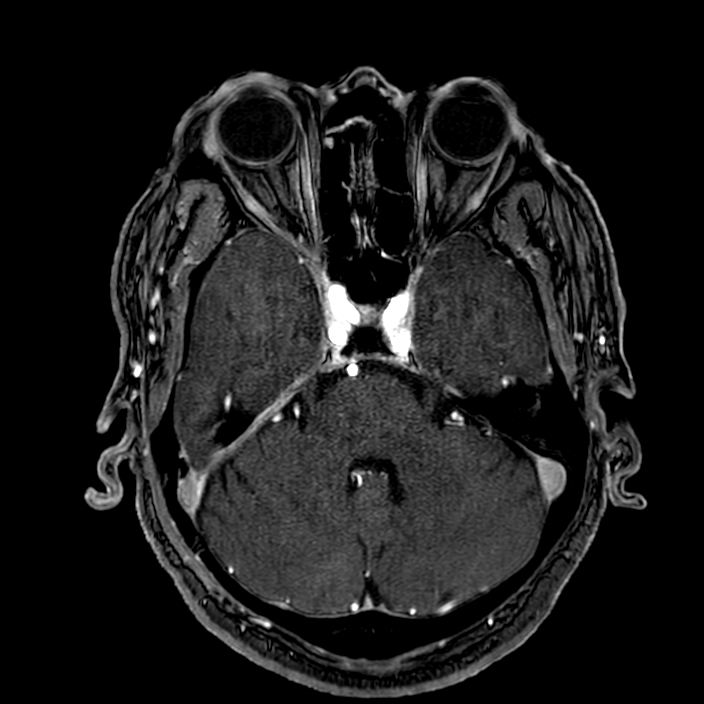 Accessory middle cerebral artery (Radiopaedia 73114-83828 Axial MRA 47).jpg