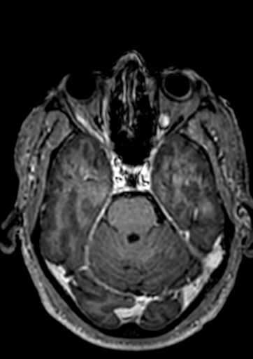 Accessory middle cerebral artery (Radiopaedia 73114-83828 Axial T1 C+ 101).jpg
