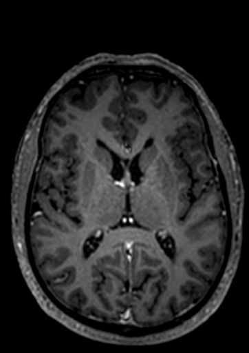 File:Accessory middle cerebral artery (Radiopaedia 73114-83828 Axial T1 C+ 19).jpg