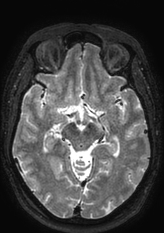 Accessory middle cerebral artery (Radiopaedia 73114-83828 Axial T2 102).jpg