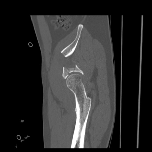 Acetabular and ilial fractures (Radiopaedia 59084-66378 Sagittal bone window 18).jpg