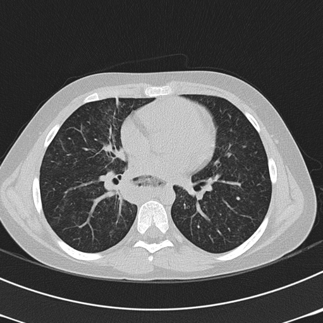 Achalasia (Radiopaedia 14946-14878 Axial lung window 41).jpg