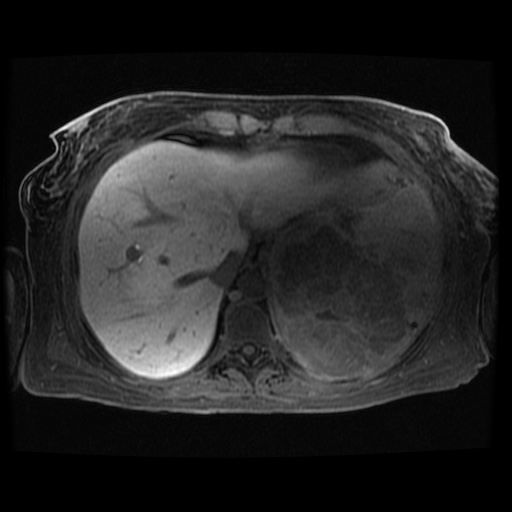 Acinar cell carcinoma of the pancreas (Radiopaedia 75442-86668 Axial late phase (~30 mins) 118).jpg