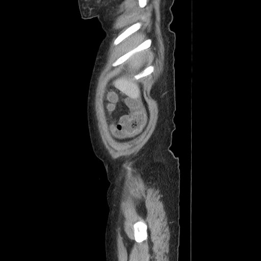Acinar cell carcinoma of the pancreas (Radiopaedia 75442-86669 Sagittal C+ portal venous phase 30).jpg