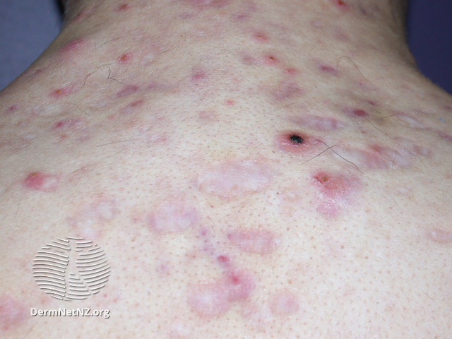 File:Acne affecting the back images (DermNet NZ acne-acne-back-166).jpg