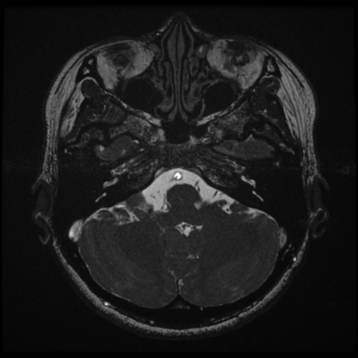 File:Acoustic neuroma (Radiopaedia 34049-35283 Axial 43).png