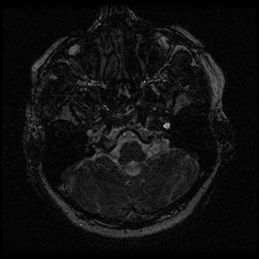 Acoustic schwannoma (Radiopaedia 33045-34060 Axial T2 6).png