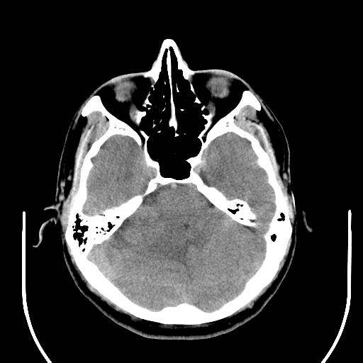 File:Acoustic schwannoma (Radiopaedia 39170-41388 Axial non-contrast 15).png