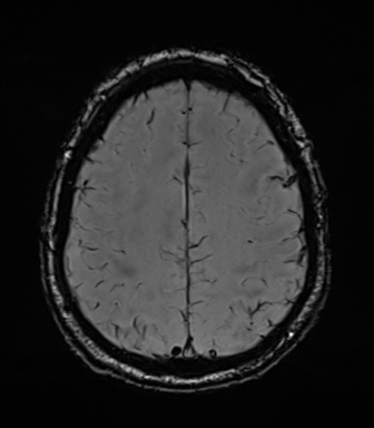 Acoustic schwannoma (Radiopaedia 50846-56358 Axial SWI 72).png