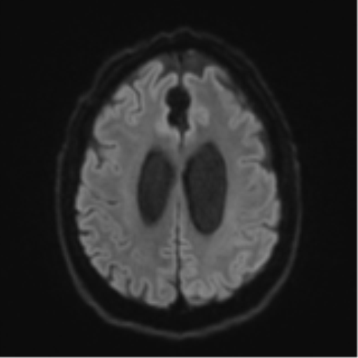 Acoustic schwannoma (Radiopaedia 55729-62281 E 47).png