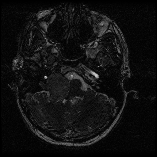 Acoustic schwannoma - eroding petrous apex (Radiopaedia 39674-42004 Axial T2 19).png