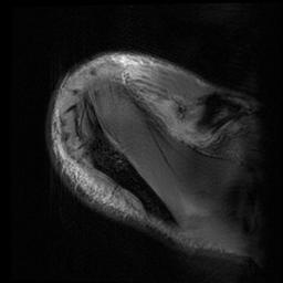 File:Acromioclavicular joint dislocation (Radiopaedia 14218-14076 Axial Gradient Echo 4).jpg