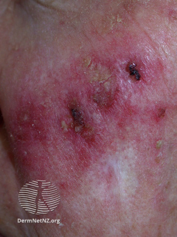 Actinic Keratoses treated with imiquimod (DermNet NZ lesions-ak-imiquimod-3768).jpg