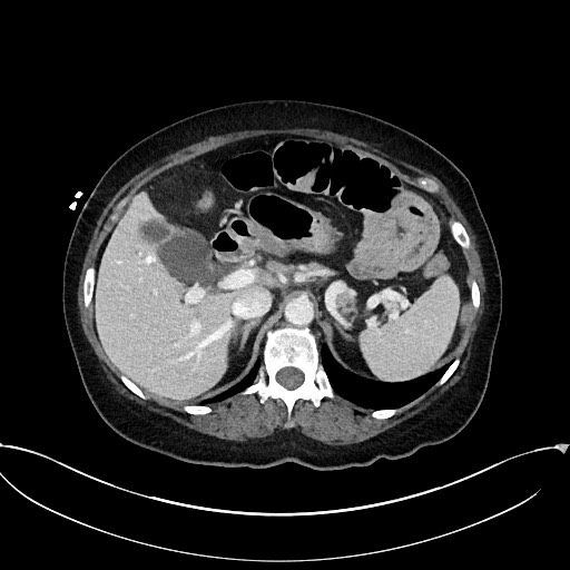 Active Crohn disease (Radiopaedia 59394-66750 Axial C+ portal venous phase 20).jpg