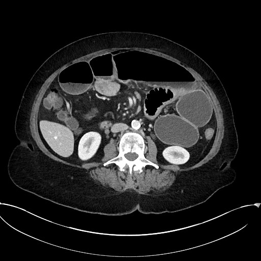Active Crohn disease (Radiopaedia 59394-66750 Axial C+ portal venous phase 37).jpg