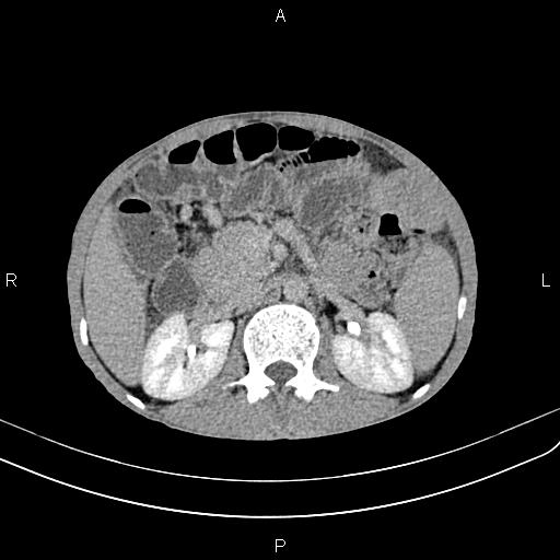 Active crohn disease (Radiopaedia 87133-103397 Axial C+ delayed 16).jpg