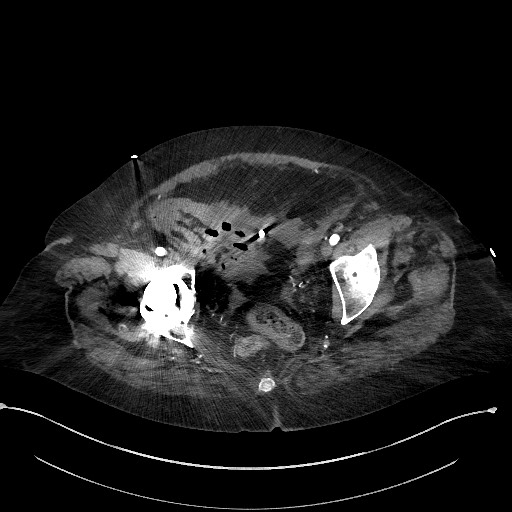 Active renal extravasation with large subcapsular and retroperitoneal hemorrhage (Radiopaedia 60975-68796 Axial C+ arterial phase 178).jpg