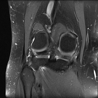File:Acute-on-chronic transient lateral patellar dislocation with trochlear dysplasia (Radiopaedia 84099-99349 Coronal PD fat sat 13).jpg