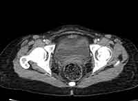 Acute Budd-Chiari syndrome (Radiopaedia 60858-68638 A 285).jpg