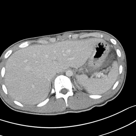 Acute appendicitis (Radiopaedia 32614-33572 Axial C+ portal venous phase 10).jpg