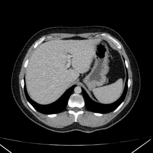 File:Acute appendicitis (Radiopaedia 38255-40270 Axial C+ portal venous phase 17).jpg