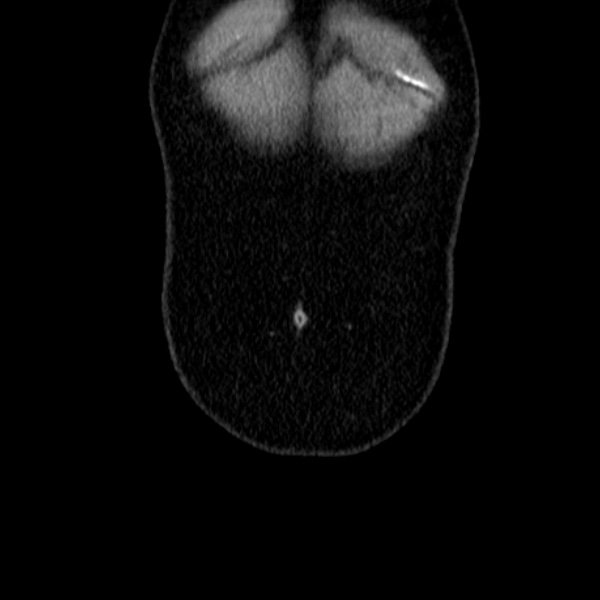 File:Acute appendicitis (Radiopaedia 38255-40270 Coronal C+ portal venous phase 8).jpg