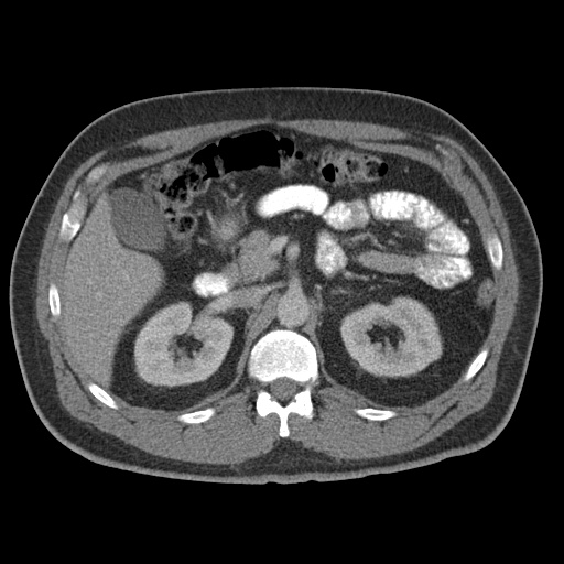 Acute appendicitis (Radiopaedia 48511-53463 Axial C+ portal venous phase 36).jpg