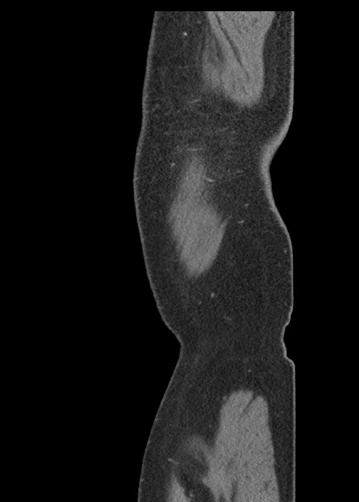Acute appendicitis (Radiopaedia 48511-53463 Sagittal C+ portal venous phase 128).jpg