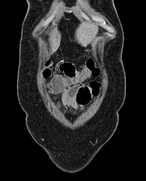 File:Acute appendicitis (Radiopaedia 48792-53822 Coronal C+ portal venous phase 38).jpg
