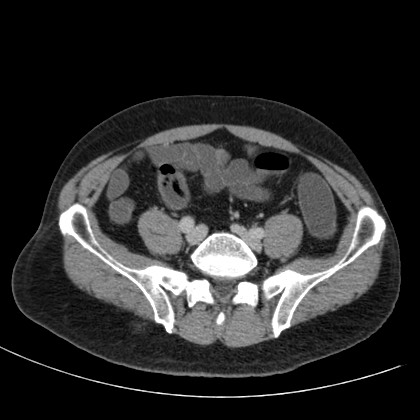 Acute appendicitis (Radiopaedia 66513-75790 Axial C+ portal venous phase 62).jpg