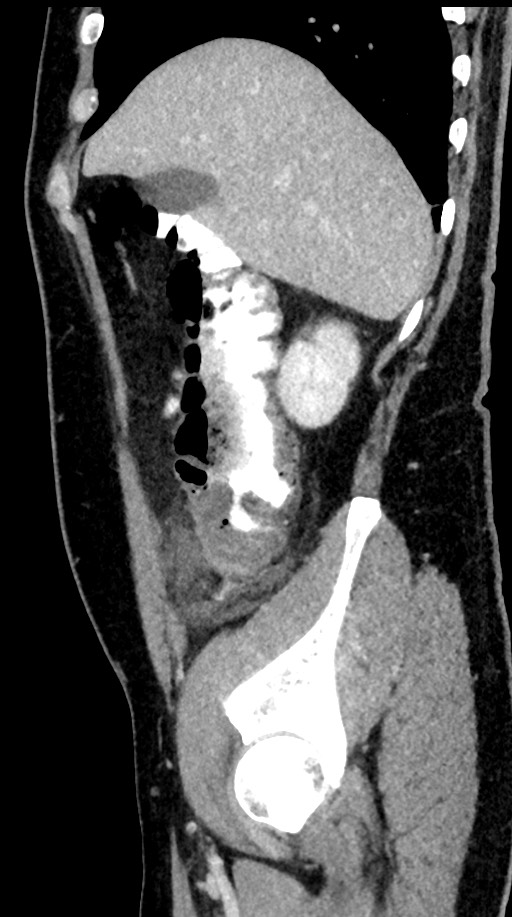 Acute appendicitis (Radiopaedia 77016-88960 Sagittal C+ portal venous phase 88).jpg
