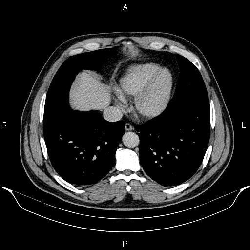 Acute appendicitis (Radiopaedia 84780-100240 Axial C+ portal venous phase 8).jpg