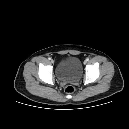 Acute appendicitis and COVID 19 pneumonia (Radiopaedia 76604-88380 Axial C+ portal venous phase 77).jpg